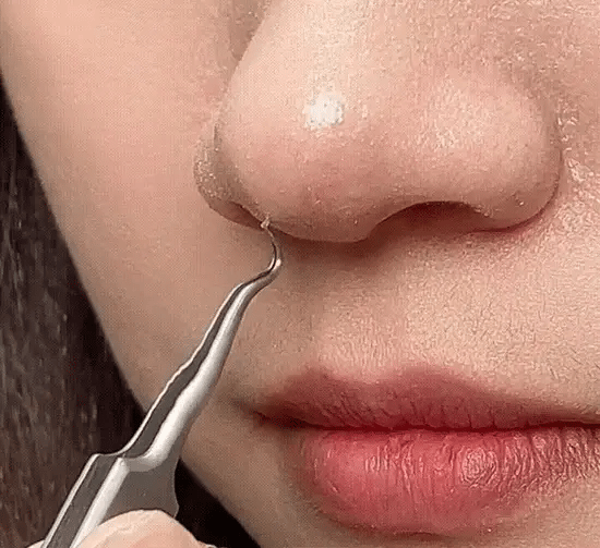 Stainless Steel Blackhead Remover Extractor Tool