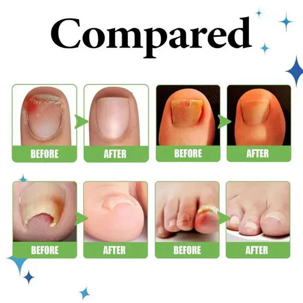 NailRevive Advanced Anti-Paronychia Oil ( Pack of 2 )