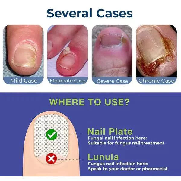 NailRevive Advanced Anti-Paronychia Oil ( Pack of 2 )