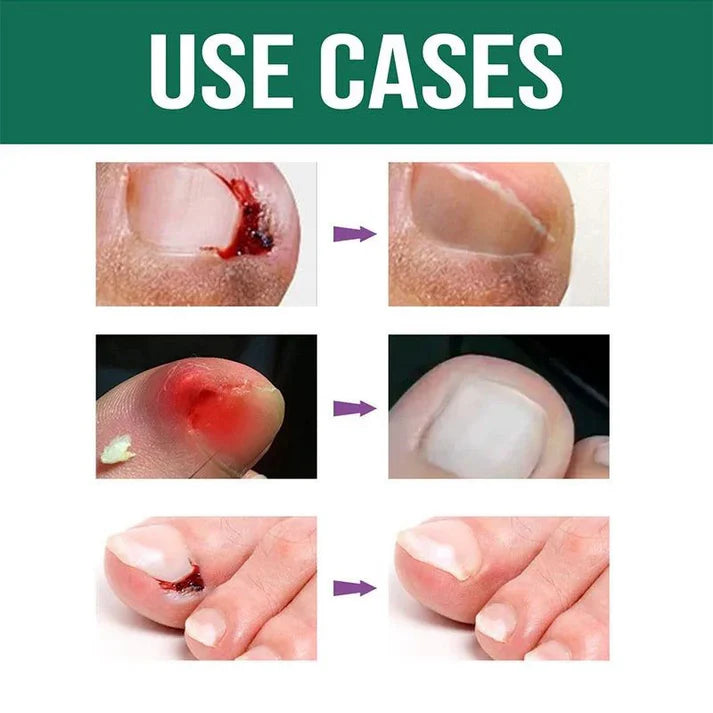 NailRevive Advanced Anti-Paronychia Oil ( Pack of 2 )